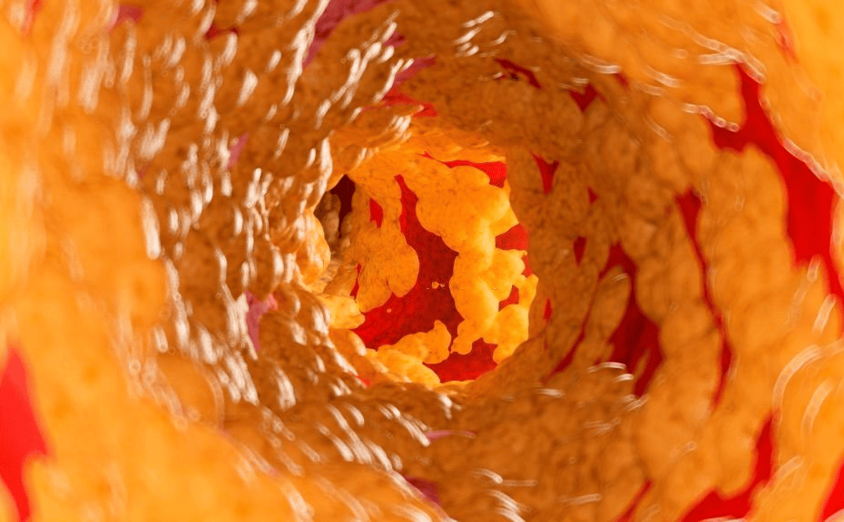 Cholesterol ,Do You Have High Cholesterol?